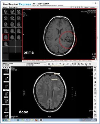 Before and after: Elena Artioli's AVM
                            decreased from 3 centimeters to 1